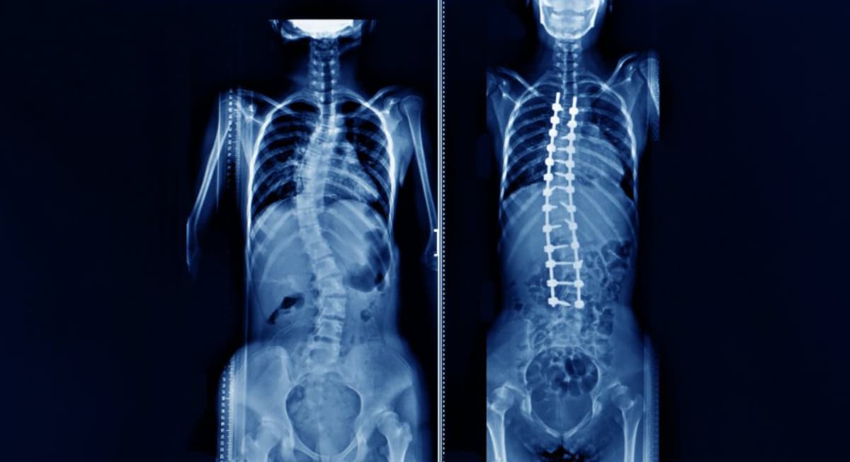 Read more about the article What is Scoliosis?